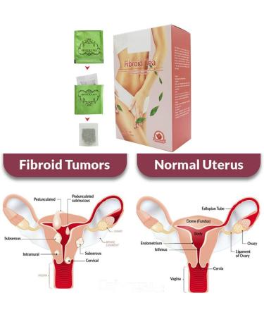 spier 20Packs / Box Th Chaud de l'ut rus Th de d sintoxication de l'ut rus Fibroid Tea pour Femme - Buy Online on GoSupps.com
