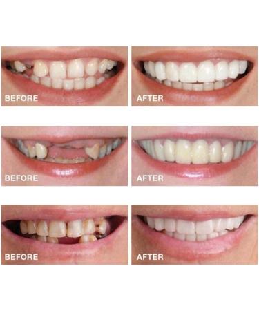 2 Pairs Veneers Dentures - Temporary Tooth Repair for Imperfect Teeth - Buy Online on GoSupps.com