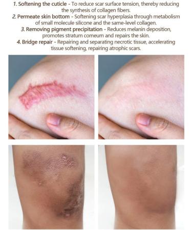 Scar Removal Cream for Face & Body - Skin Remover for Scars & Marks (White, One Size) - Buy Online on GoSupps.com