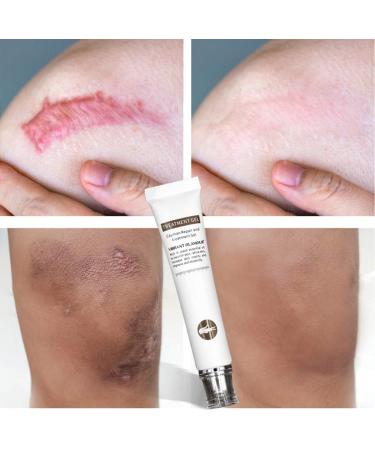 Scar Removal Cream for Face & Body - Skin Remover for Scars & Marks (White, One Size) - Buy Online on GoSupps.com