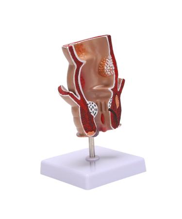 Jaquiain Anatomy Model Human Rectal Hemorrhoid Lesion Model Hemorrhoid Fistula Fistula Fissure Pathology Teaching Model