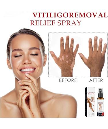 YSGBYSG Vitiligo & Psoriasis Relief Spray - Skin Repair Treatment (2PCS) - Buy Online on GoSupps.com