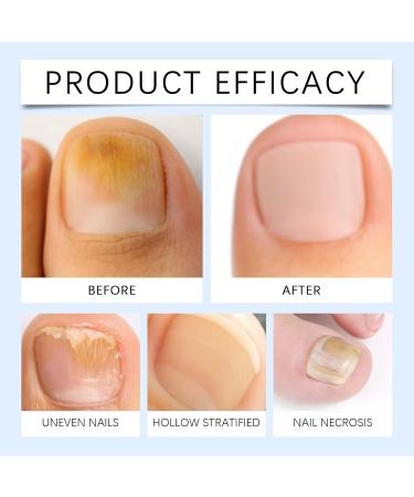 Zouwinforever Nail care with hyaluronic acid vitamin E and jojoba oil for hard strong nails and healthy growth for men and women - Buy Online on GoSupps.com