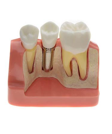 Samnuerly dental implant implementation model 4-way dental implant analysis-analysis-crown bridge demonstration model tooth crown roots for training removable