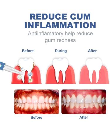 GNHG 3 Pieces Periodontal Treatment Free Smile Gingival Gel Instant Gum Treatment And Recovery - Buy Online on GoSupps.com