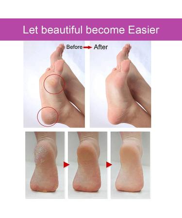 Emjoi Micro-Pedi Callus Remover - Smooth and Soft Feet in Minutes - Buy Online on GoSupps.com