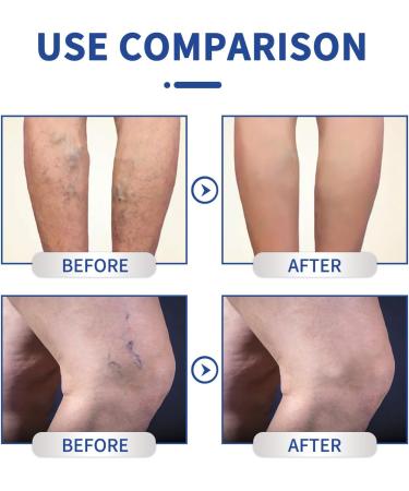 Vein Relief Cream 20g - Natural Varicose Vein Gel for Pain Relief - Buy Online on GoSupps.com
