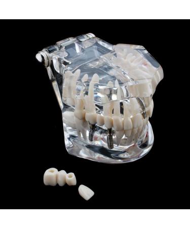 Boxwizard Tooth Model for Dentistry Students | Typodont Dental Diseases Teaching Aid - Adult Demonstration Tooth Model - Buy Online on GoSupps.com