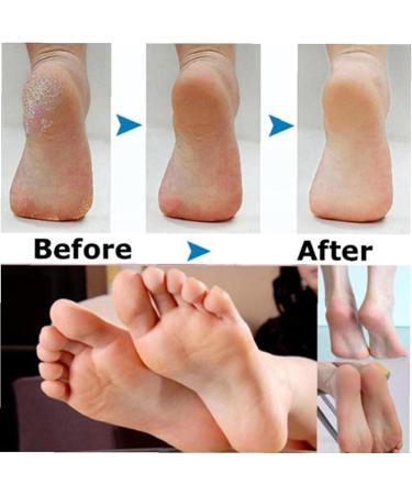 TOSSPER 5pcs Foot Exfoliator Remover - Replacement Roller Tool for Smooth Feet | Best Foot Care Solution - Buy Online on GoSupps.com