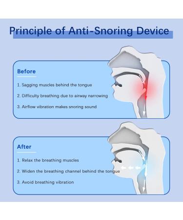 Smart Adjustable Snoring Stopper - Electric Anti-Snoring Device for Better Sleep - Buy Online on GoSupps.com