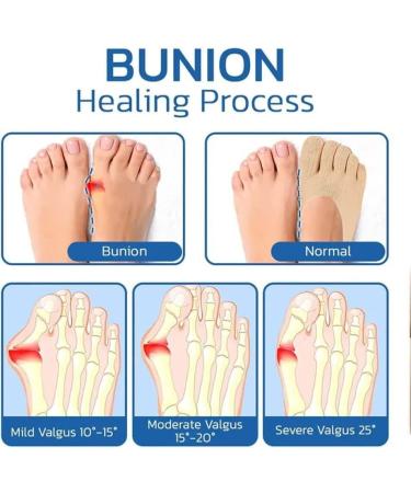 2023 Ergoic Anti-Bunions Health Socks - 5 Pairs - Toe Alignment for Bunions - Apricot - Buy Online on GoSupps.com