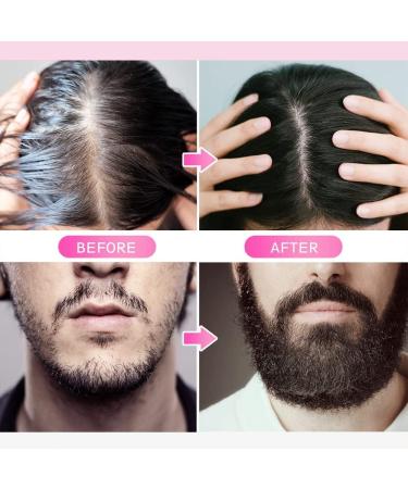 Derma Roller for Skin Beard Derma Roller for Hair Growth & Care Facial Roll Micro needling 0.25mm 0.5mm 1mm 1.5mm 540 Titanium Micro Needles for Facial Body & Hair Growth For Men & Women (0.25mm) - Buy Online on GoSupps.com