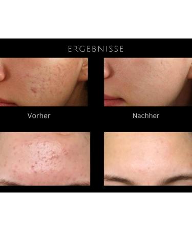 Bart Roller Dermaroller 540 Titanium Needles 0.25mm | King Vic Derma Beard Roller for Face & Body | Professional Microneedling Tool to Stimulate Beard & Hair Growth - Buy Online on GoSupps.com