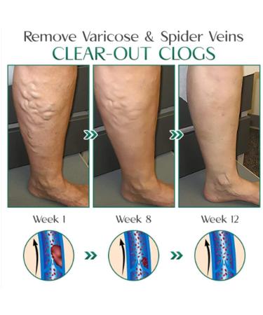 Buy Varicose Vein Treatment Soap - Ginger Infused Wood Soap for Smooth Skin (1 Piece) - International Shipping Available - Buy Online on GoSupps.com
