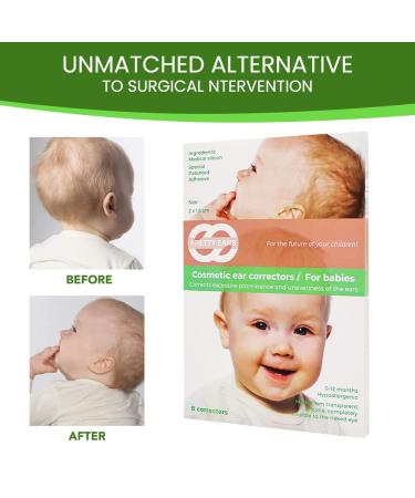 PrettyEars Cosmetic Ear Correctors for Babies - 4 Pairs, Transparent Silicone Adhesive Tape for Prominent Protruding Ears - Buy Online on GoSupps.com