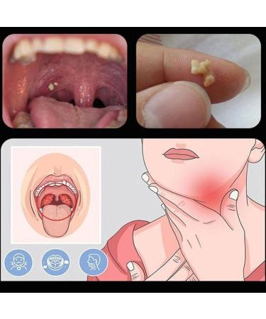 Zoubaoq Tonsil Stone Remover Tool Set - Manual Mouth Cleaning & Personal Health Care - 3PCS  - Buy Online on GoSupps.com