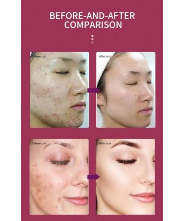 Professional Fruit and Almond Acid Essence Serum for Acne Treatment Exfoliating and Skin Softening - Buy Online on GoSupps.com