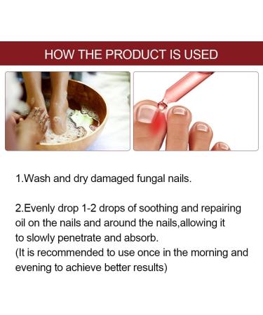 Ingrow Toenail Correction Treatment Oil Ingrown Toenail Correction Drops Cuticle Care Oils for Ingrown Toenails Nail Care and Treatment Ingrown Toenail Drops Ingrowing Toenail Treatment 10ML - Buy Online on GoSupps.com