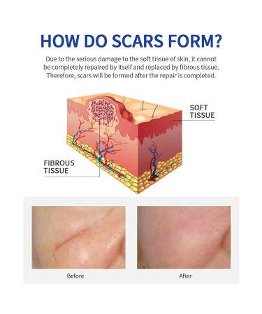 Scar Water Liquid 30ml - Moisturizing Scar Oil for Ordinary Skin Care (One Size, Color) - Buy Online on GoSupps.com