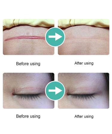 SILICONE SCAR SHEETS | Professional Gel Patch for Scar Removal, Stretch Marks, Keloids | C-Section & Stomach Pads for Men & Women - Skin Care Stickers - Buy Online on GoSupps.com