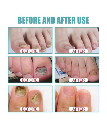 Mify 10ml Nail Fungus Treatment | Nail & Toenail Care Liquid | Fast-Acting Foot Care Solution - Buy Online on GoSupps.com
