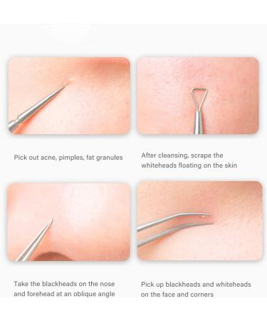 Blackhead Removal Tool Kit - Professional Stainless Steel Extractor for Acne, Blackheads, Whiteheads on Face and Nose - Buy Online on GoSupps.com
