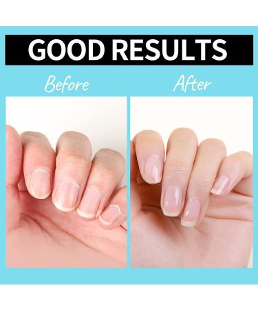 Cuticle Remover Tools Set - Trimmer, Pusher, Softener, Oil, File, Nipper for Nail Care by Teenitor - Buy Online on GoSupps.com