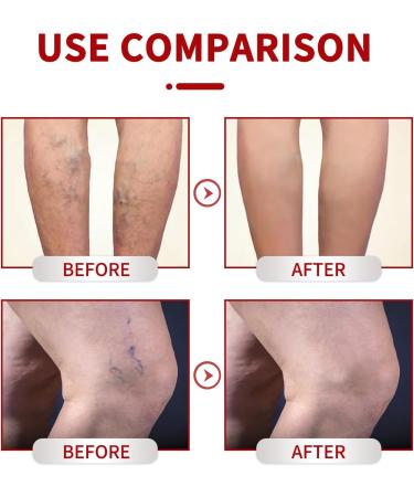  KOAHDE Cream for varicose veins cream for varicose veins cream for varicose veins cream for varicose veins cream for varicose veins 20g - Buy Online on GoSupps.com