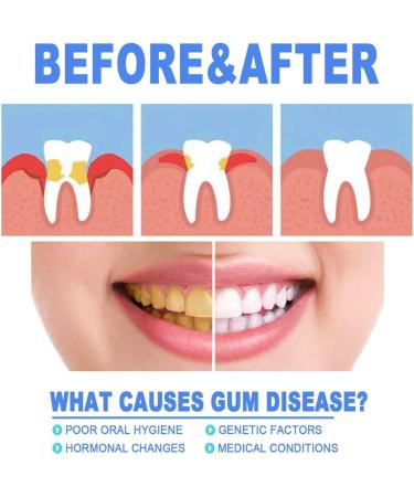 Lovilds Gums Therapy Gel & Teeth Whitening Essence Effective Gum Shield & Stain Remover | International Shipping - Buy Online on GoSupps.com