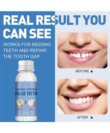 Temporary Dental Repair Beads - Fast Denture Fix for Missing & Broken Teeth Degradable Tooth Filling Material (30g) - Buy Online on GoSupps.com