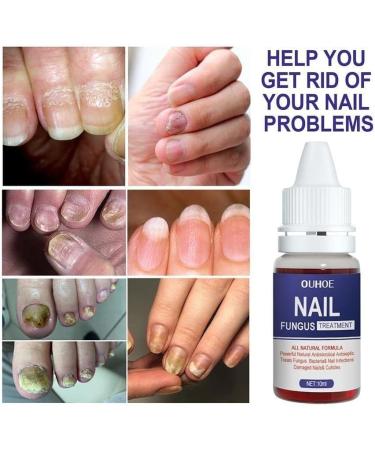 ZERZK 10ml Repair Nail Fungus Treatments Essence Foot Care Nails AntiInfection Toe Fungus Serum Onychomycosis Removal Gel - Buy Online on GoSupps.com