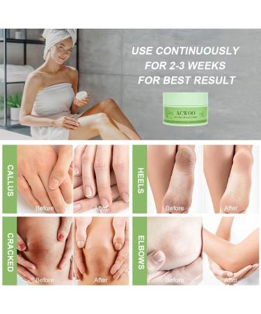  ACWOO ACWOO Foot cream soothing foot moisturizer removes calluses foot cream tea tree and aloe vera for deep hydration for very feet - Buy Online on GoSupps.com