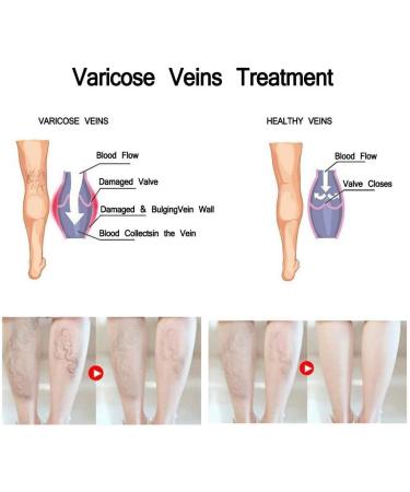 Varicose & Spider Veins Cream for Legs - Improve Blood Circulation, Varicose Care Ointment (50g) - Buy Online on GoSupps.com