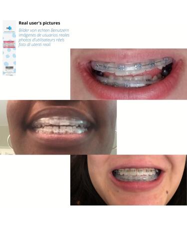 Buy Mouth Protection for Braces | Reusable Taste-Free Orthodontic Wax Alternative | Prevent Lip Wounds - Buy Online on GoSupps.com