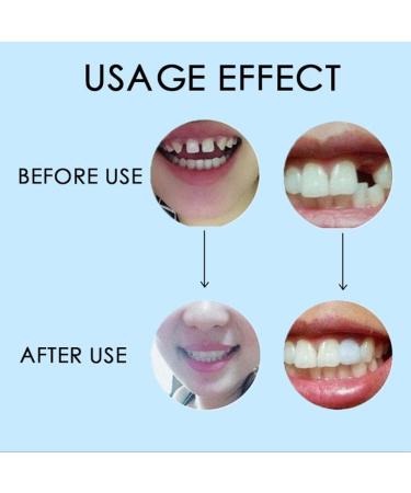 Jojomi Thermo-Pearl Tooth Veneer Set | Temporary Denture Repair for Broken Missing & Uneven Teeth - 10g - Buy Online on GoSupps.com