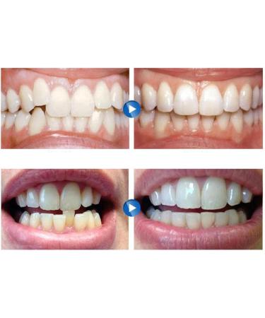 Set of 5 Transparent Mouth Guards for Teeth Grinding - Night Guard for Sleep Support - Buy Online on GoSupps.com