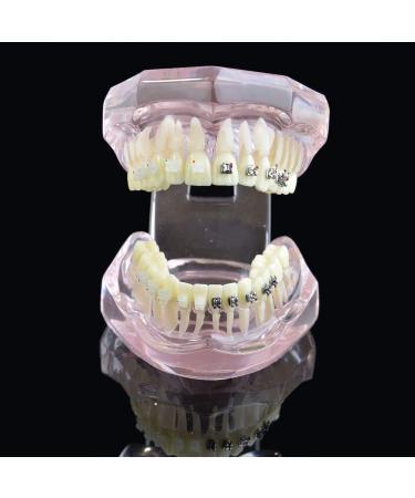 LBYLYH Orthodontic Demonstration Model - Teeth Teaching Tools with Metal & Ceramic Support for Effective Dental Treatment - Buy Online on GoSupps.com