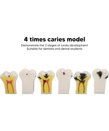 4-Fold Caries Model for Dental Education | Tooth Caries Simulation & Diagnostic Training | Portable for Dentists & Students - Buy Online on GoSupps.com