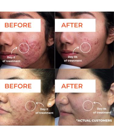 RAOOF MD Acne Brightening Pads - 5% Glycolic Acid & 2% Salicylic Acid Pads for Face & Body - 60 Count - Buy Online on GoSupps.com