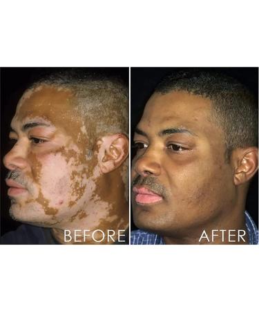 Vitiligo Treatment Spray - Skin Pigmentation Care & White Spot Reduction (2pcs) - Buy Online on GoSupps.com