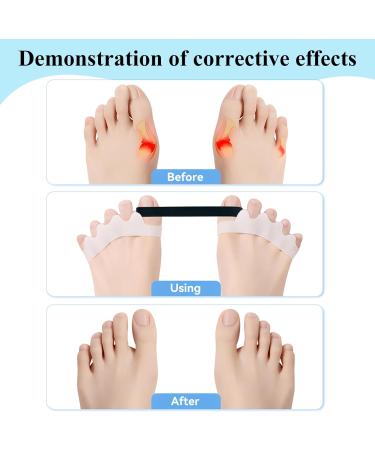 3 Pairs White Gel Toe Separators & Stretchers | Toe Spacer for Overlapping Toes | Correct Bunions & Relax Toes | Ideal for Running, Yoga, Pedicure - Buy Online on GoSupps.com