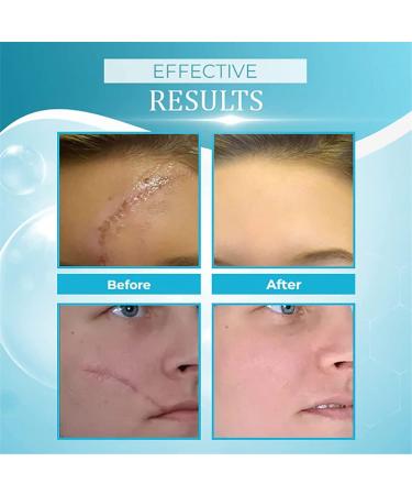 PICKX Organic Scar Removing Gel - Keloid & Surgical Scar Removal Cream - Lightens Scars and Acne Marks - Gentle on Sensitive Skin (1PC) - Buy Online on GoSupps.com