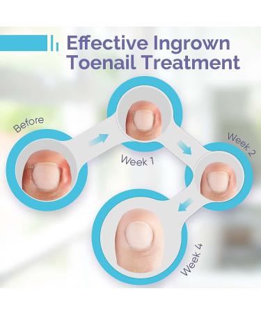 Ingrown Toenail Treatment & Pain Reliever - Softens for Easy Trimming | 30ml - Buy Online on GoSupps.com