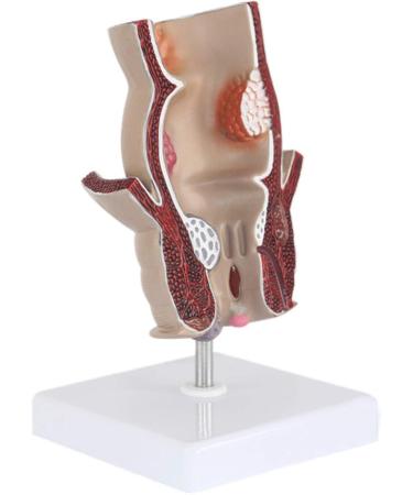Medical Science Rectum Fissure Lesion Model 5X Human Anorectal Pathology Model Hemorrhoid Anal Fistula School Educational Teaching Accessory Part - Buy Online on GoSupps.com