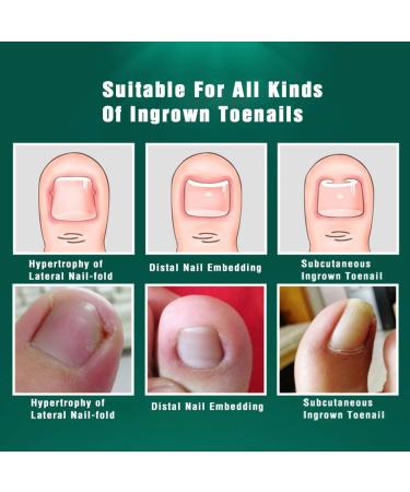 Bezox 2PC Ingrown Toenail Tools - Nail Correction Buckle & Lifter Surgical Stainless Steel for Paronychia Treatment (Size 37-40) | International Shipping Available - Buy Online on GoSupps.com