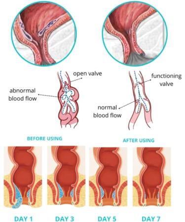 Heca Natural Herbal Hemorrhoid Capsules - Treatment & Relief for Women (5 Boxes) - Buy Online on GoSupps.com
