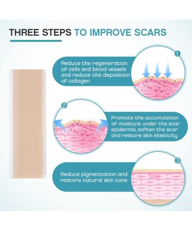 Silicone Scar Strips 1.6''x6'' - 4 pcs Multi-Use Scar Removal Cream (2 Month Supply) - Reusable Scar Tape - Flesh Color - Buy Online on GoSupps.com