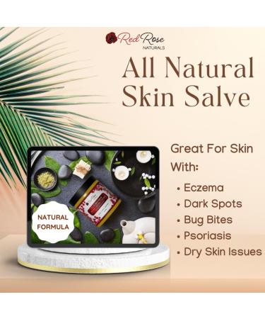 Red Rose Naturals TLC Skin Salve - 100% All Natural Balm for Eczema, Psoriasis, Acne, Dark Spots, Rashes, and Dry Skin - Buy Online on GoSupps.com