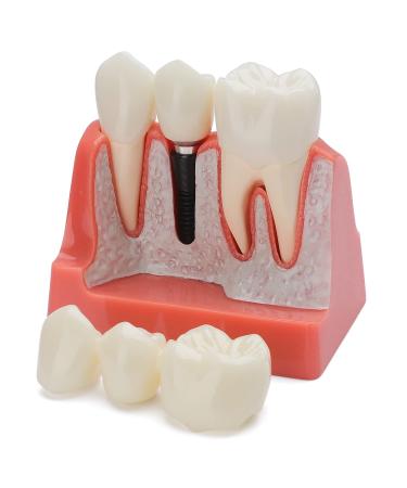 Dental Implant Model - 4 Times Removable Analysis Crown Bridge Demonstration Teeth Model Dental Implant Analysis Tooth Model for Learning and Education