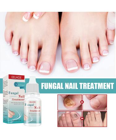 Mify 10ml Nail Fungus Treatment | Nail & Toenail Care Liquid | Fast-Acting Foot Care Solution - Buy Online on GoSupps.com